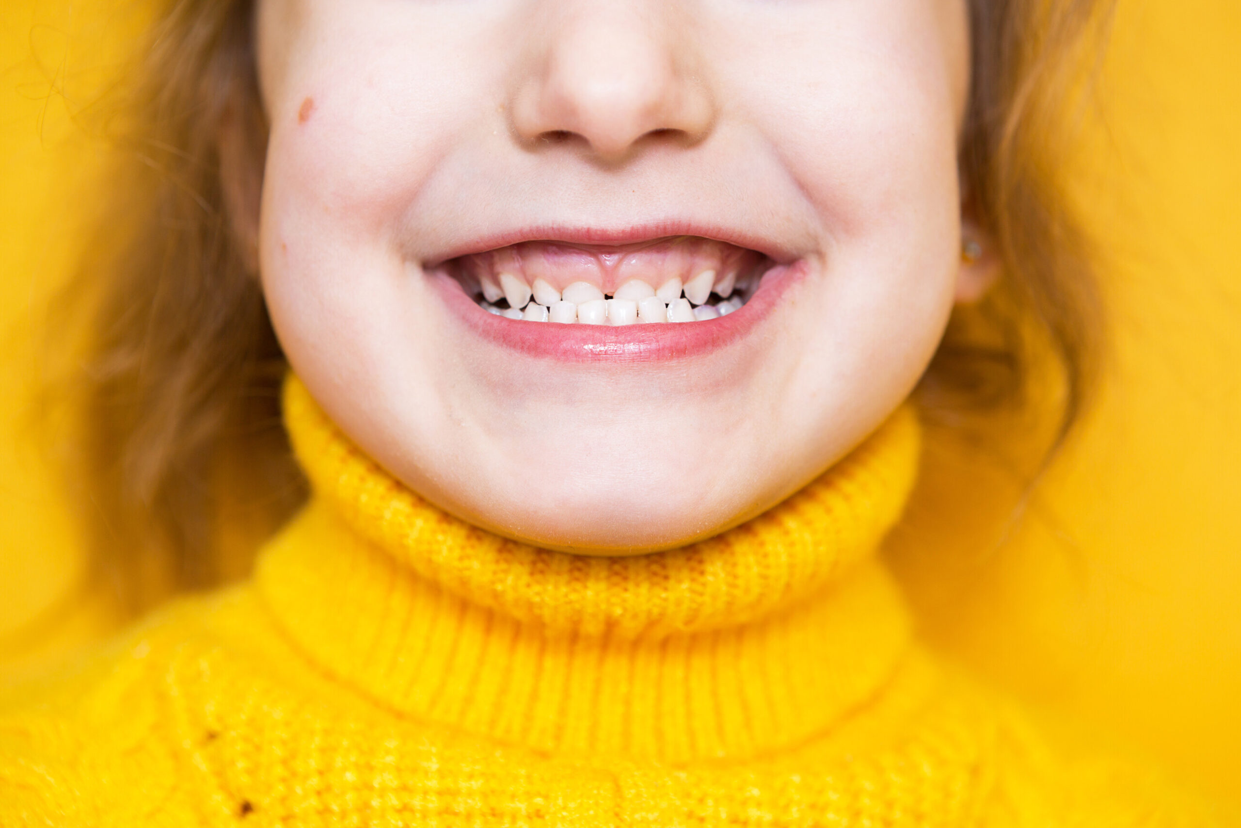 Little girl smiling with an underbite.